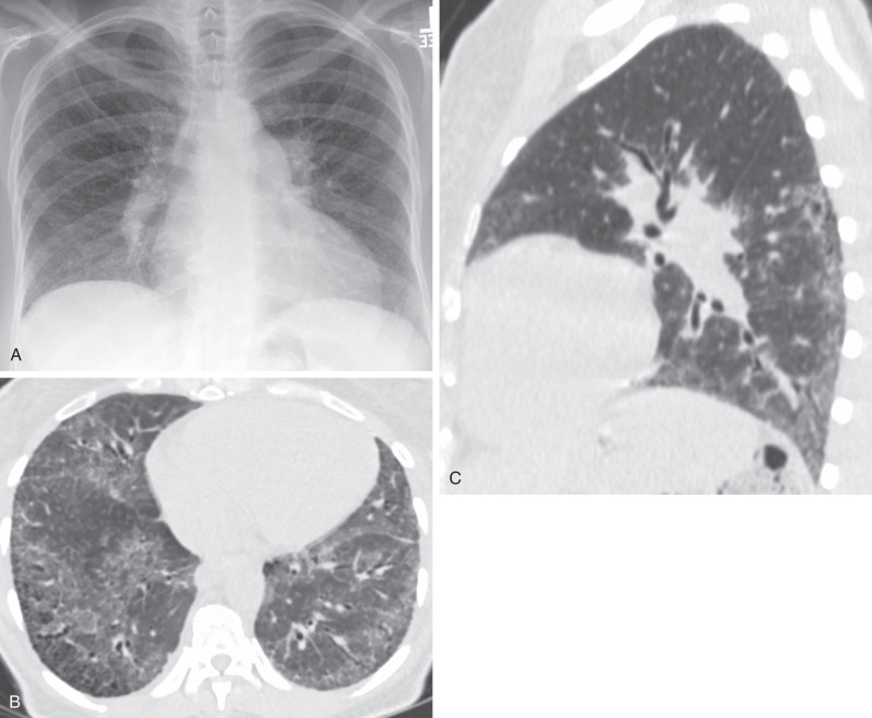 Mixed Connective Tissue Disease | Radiology Key