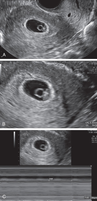 Empty sac tilted uterus ultrasound causes of