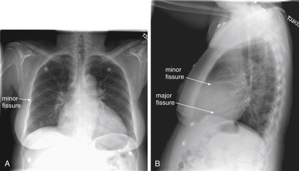 Imaging the Chest: The Chest Radiograph