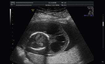 cystic hygroma ultrasound