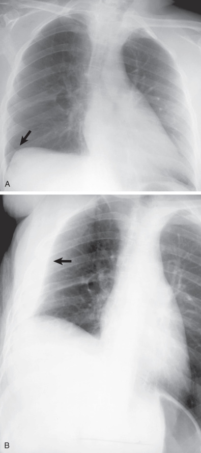 pleural effusion x ray lateral