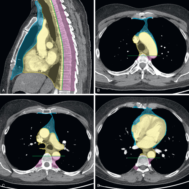 mediastinal-masses-radiology-key