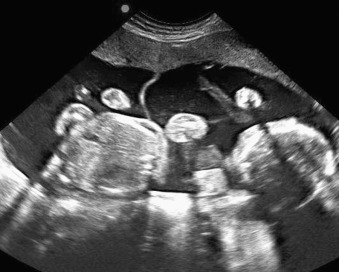 Ultrasound images pregnancy twin Monochorionic diamniotic