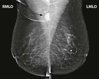 MAMMOGRAPHY  Radiology Key