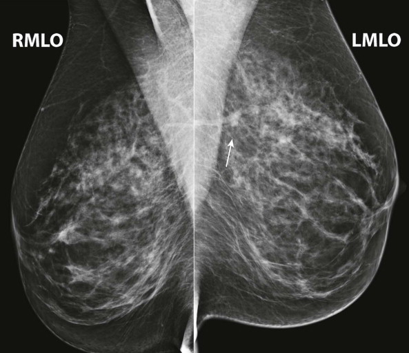 MAMMOGRAPHY  Radiology Key