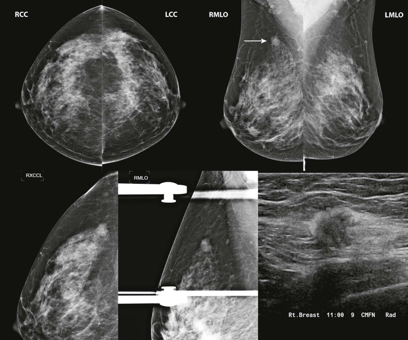 Screening Mammography 101 And Beyond Radiology Key