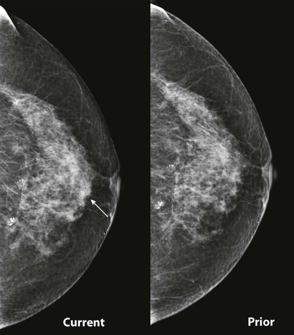 MAMMOGRAPHY  Radiology Key