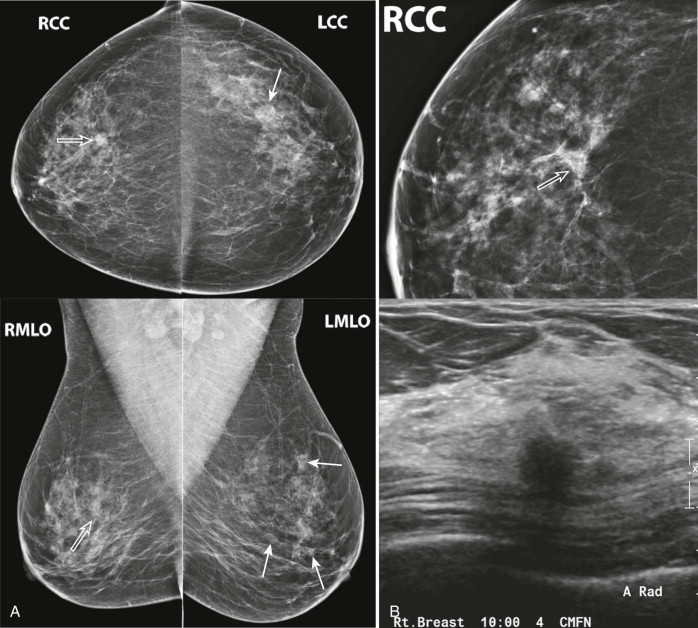 Mammography: Masses - Radiology