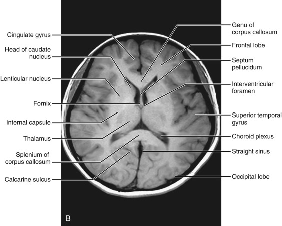 Mri anatomy brain Brain