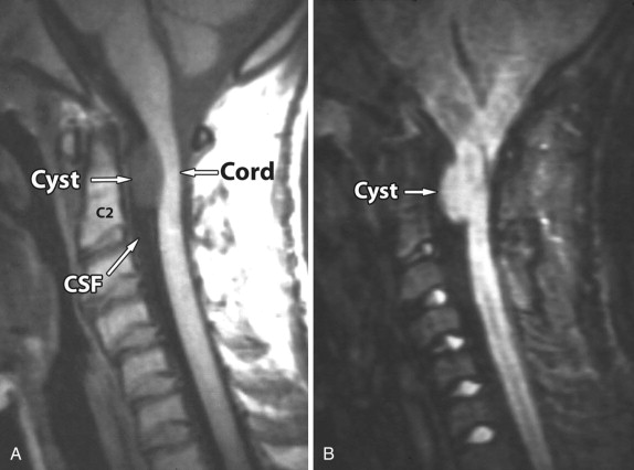 Arachnoid Cyst Radiology Key