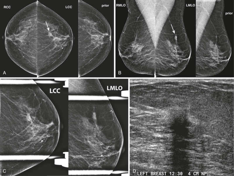Breast Asymmetry & Asymmetric Boob Surgery Malaga