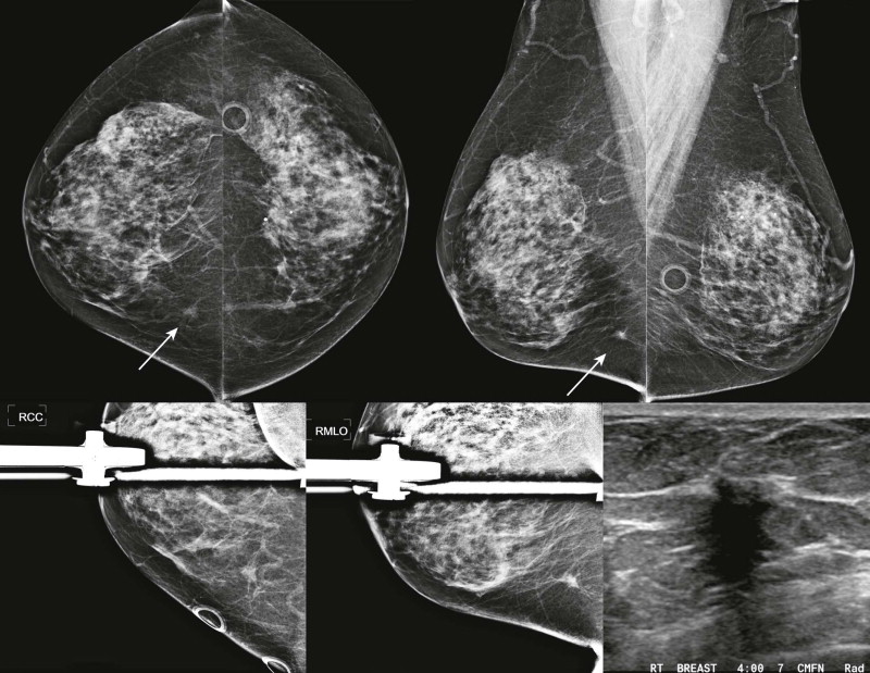 Finding Cancers in Dense Tissue