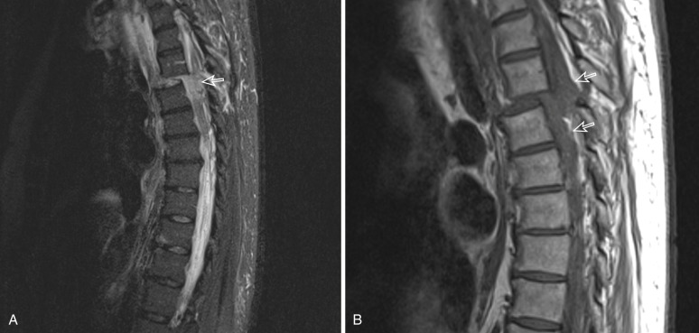 Spinal Cord Injury Radiology Key