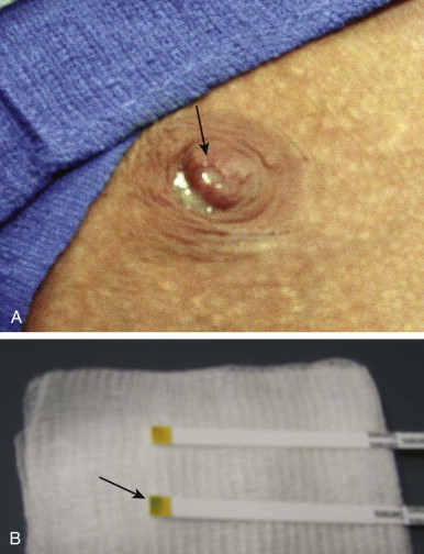 Nipple Discharge  Understanding Clear & Bloody Nipple Discharge