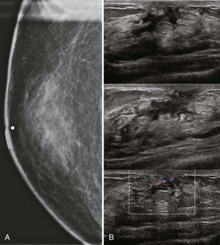 Male Gynecomastia Ultrasound Radiology