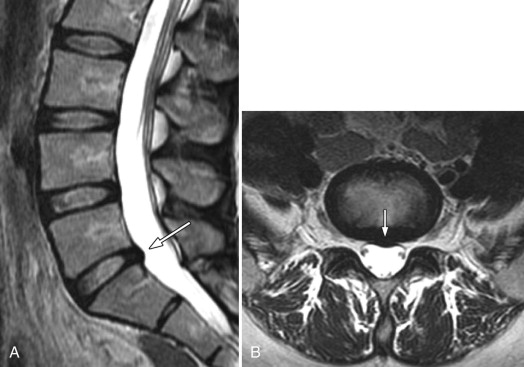 Disc HerniationLumbar Radiology Key