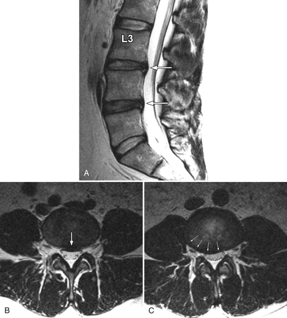 Herniated Disc Mri L S Lumbar Herniated Disc A More In Depth Look My Xxx Hot Girl 