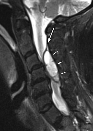 spinal epidural hematoma