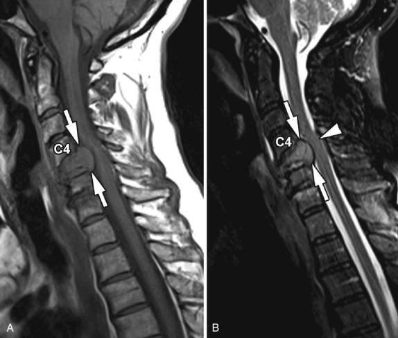Pathologic compression fracture with enhancing bone marrow signal