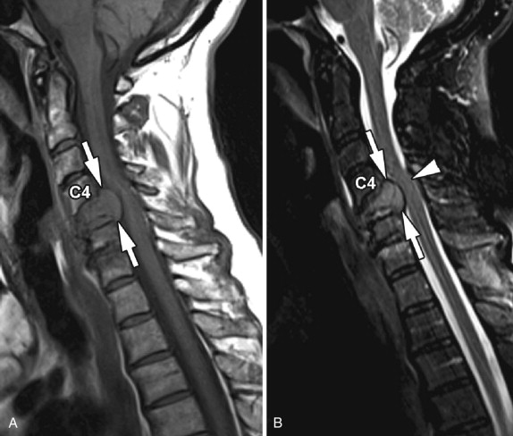 Figure 2 from Vertebral compression fractures in the elderly.