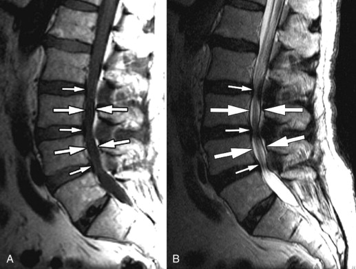 Spinal Stenosis  Neurological Surgery