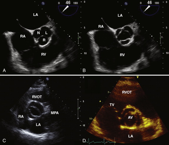 aortic valve echo