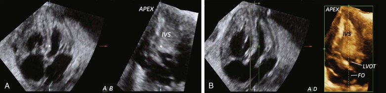 Three And Four Dimensional Imaging In Fetal Echocardiography