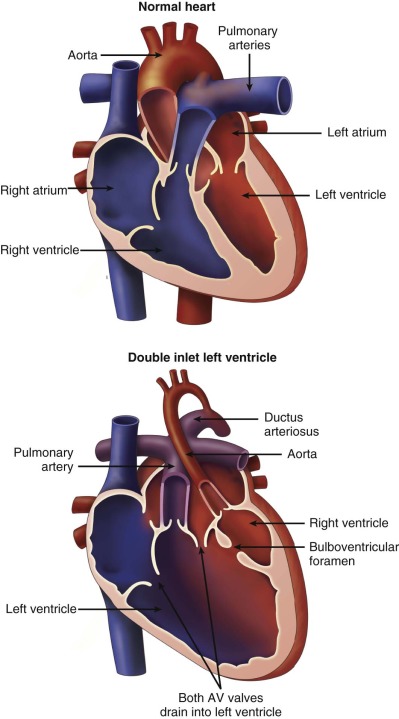 Double Inlet Left Ventricle Radiology Key