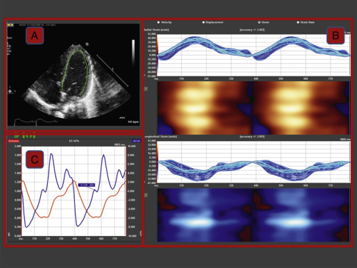 Speckle-tracking echocardiography. Semiautomatic calculation of global