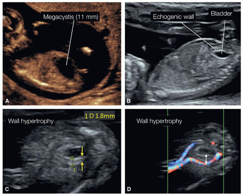 The Fetal Urogenital System | Radiology Key
