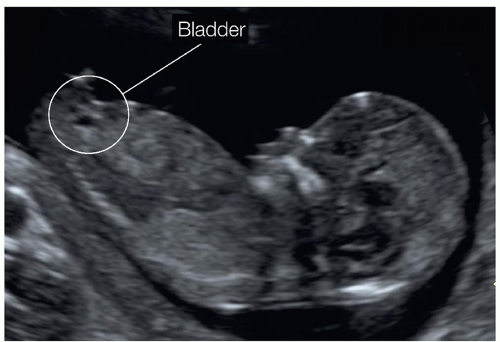 The Fetal Urogenital System | Radiology Key