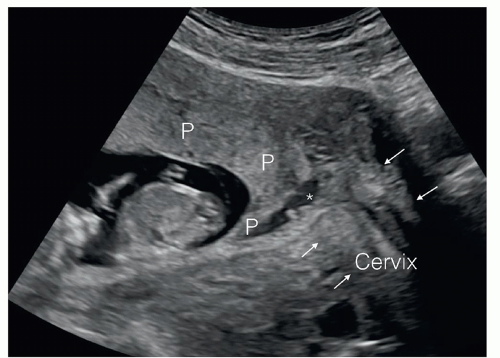 The Detailed First Trimester Ultrasound Examination Radiology Key 4916