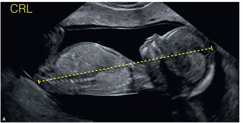 The Detailed First Trimester Ultrasound Examination Radiology Key 