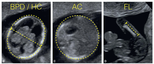 The Detailed First Trimester Ultrasound Examination Radiology Key 