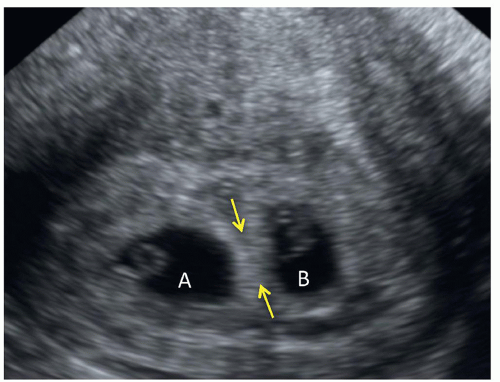8 week ultrasound fraternal twins