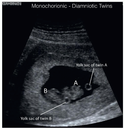 8 week ultrasound identical twins