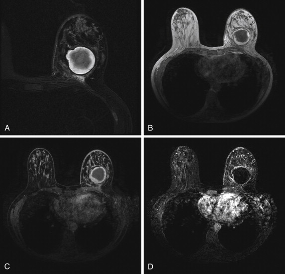 Fat necrosis (breast), Radiology Reference Article