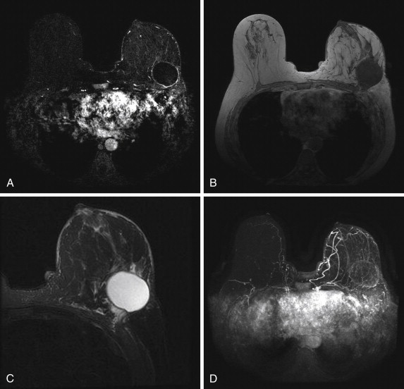 Postoperative breast edema, Radiology Case