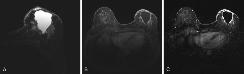 Postoperative breast edema, Radiology Case