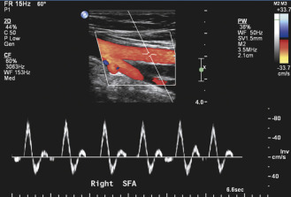 Ultrasound Assessment Of Lower Extremity Arteries Radiology Key