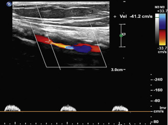 Ultrasound Assessment Of Lower Extremity Arteries Radiology Key Ultrasound Assessment Of Lower Extremity Arteries Radiology Key