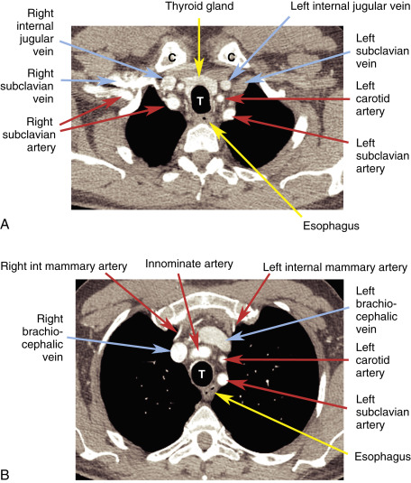 Mediastinum