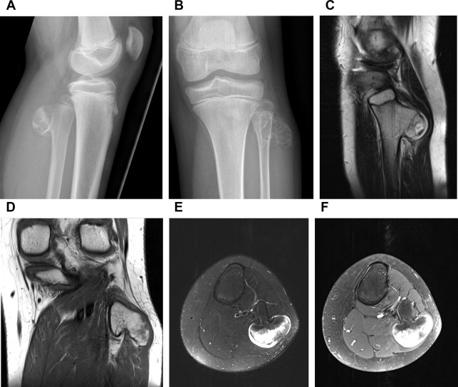 Imaging Features Of Bone Tumors Radiology Key 1213