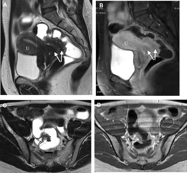 Magnetic Resonance Enema In Rectosigmoid Endometriosis | Radiology Key