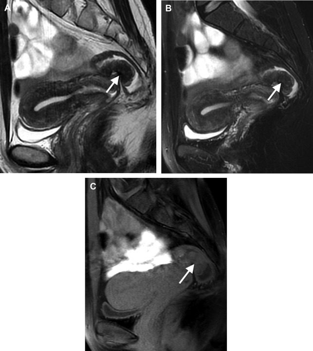 Magnetic Resonance Enema In Rectosigmoid Endometriosis | Radiology Key