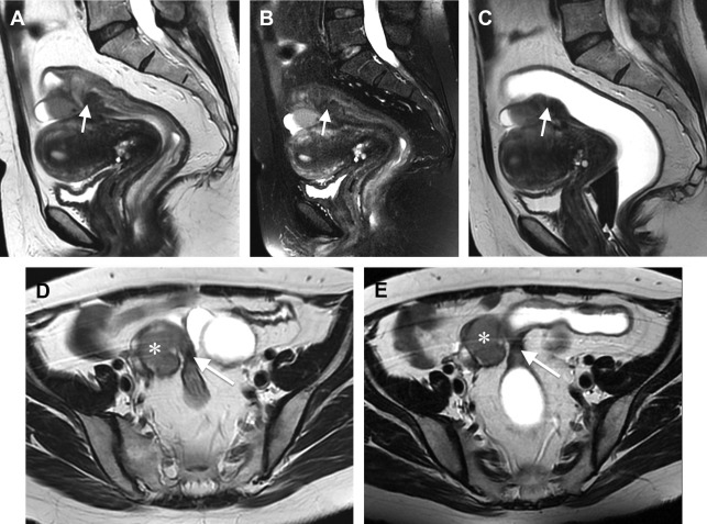 Magnetic Resonance Enema In Rectosigmoid Endometriosis | Radiology Key