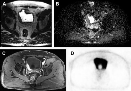 Magnetic Resonance Imaging In Rectal Cancer Radiology Key