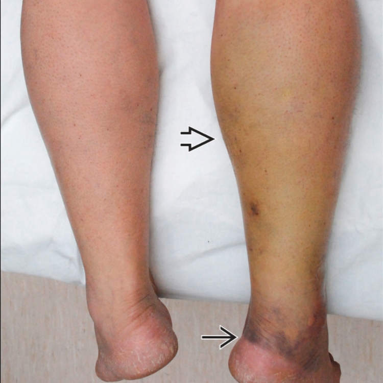 Spontaneous Bilateral Medial Head Of Gastrocnemius Muscle Rupture BMJ Case  Reports