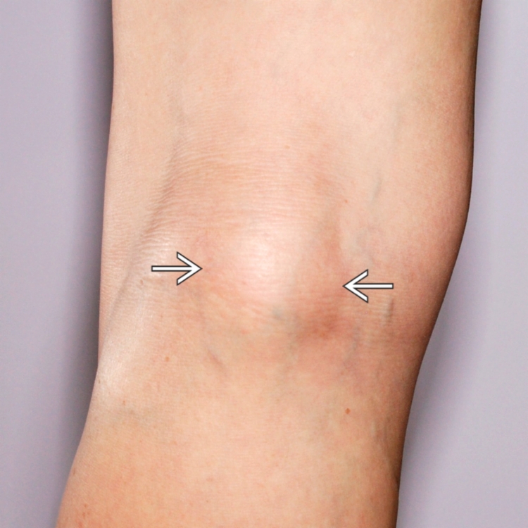 popliteal-fossa-swelling