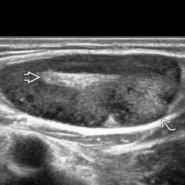 Lymph Node Abnormality Radiology Key